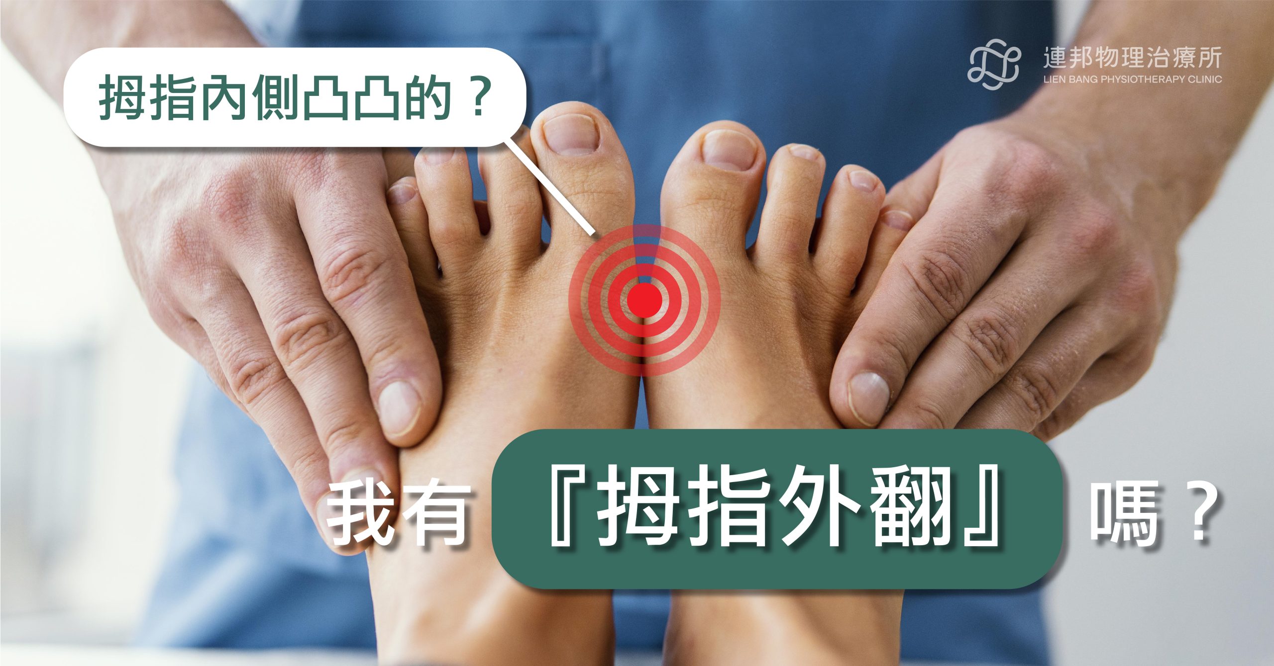 拇趾外翻 症狀示意圖,大腳趾朝外偏移,物理治療師教學